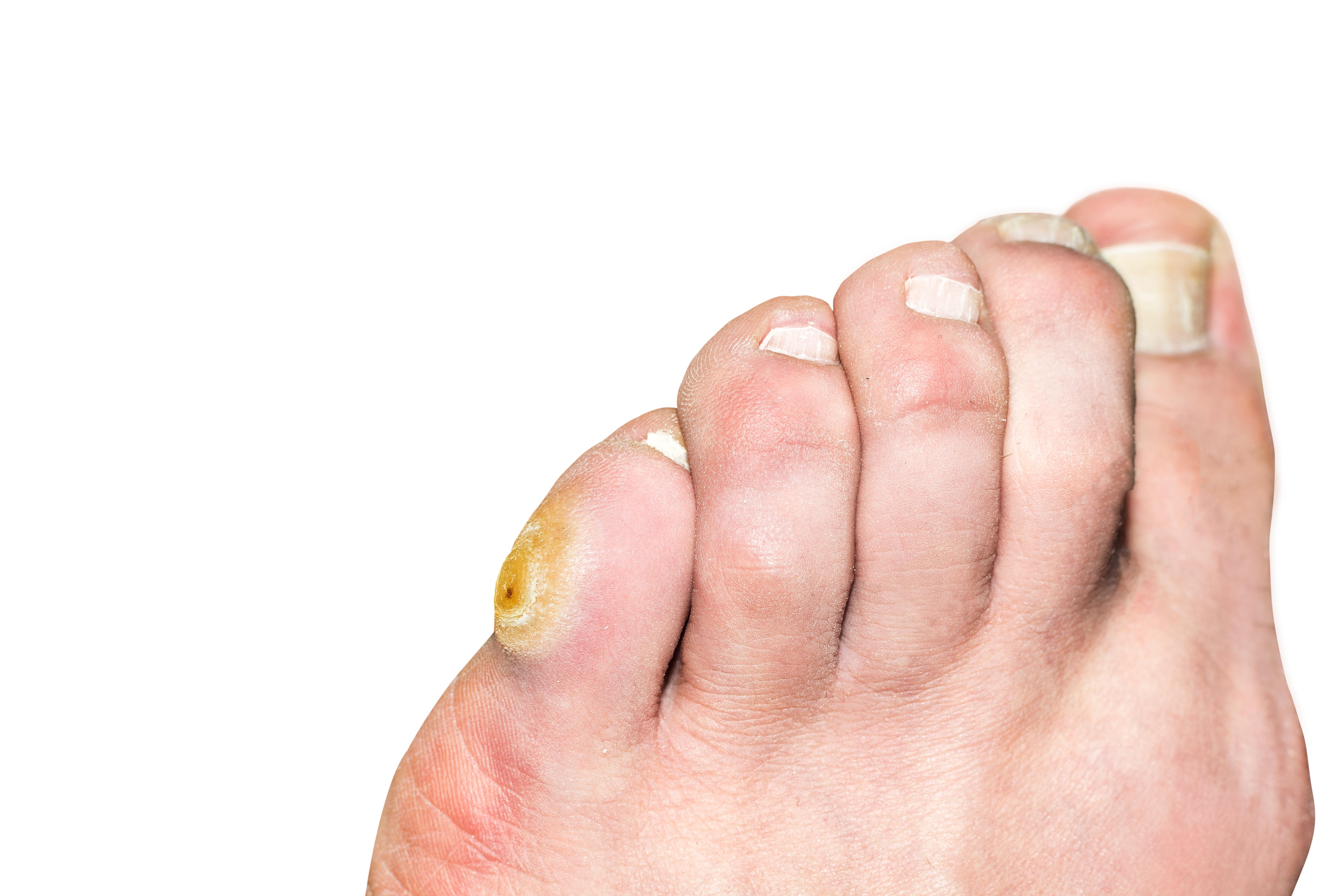 How to get rid of corns on the foot?
