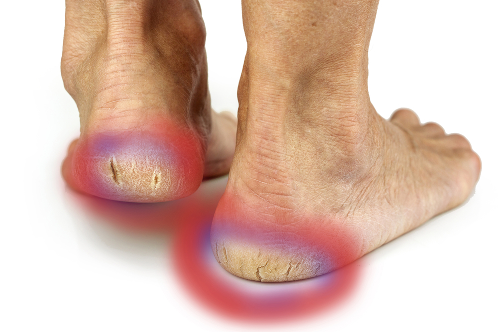 Cracked Heels Causes | Family Foot & Ankle Centers