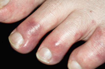 chilblain-Acanthosis-nigricans-Dr-Qaisar-Ahmed-Causes-Symptoms-Treatment-Best-Homeopathic-doctor-Pakistan