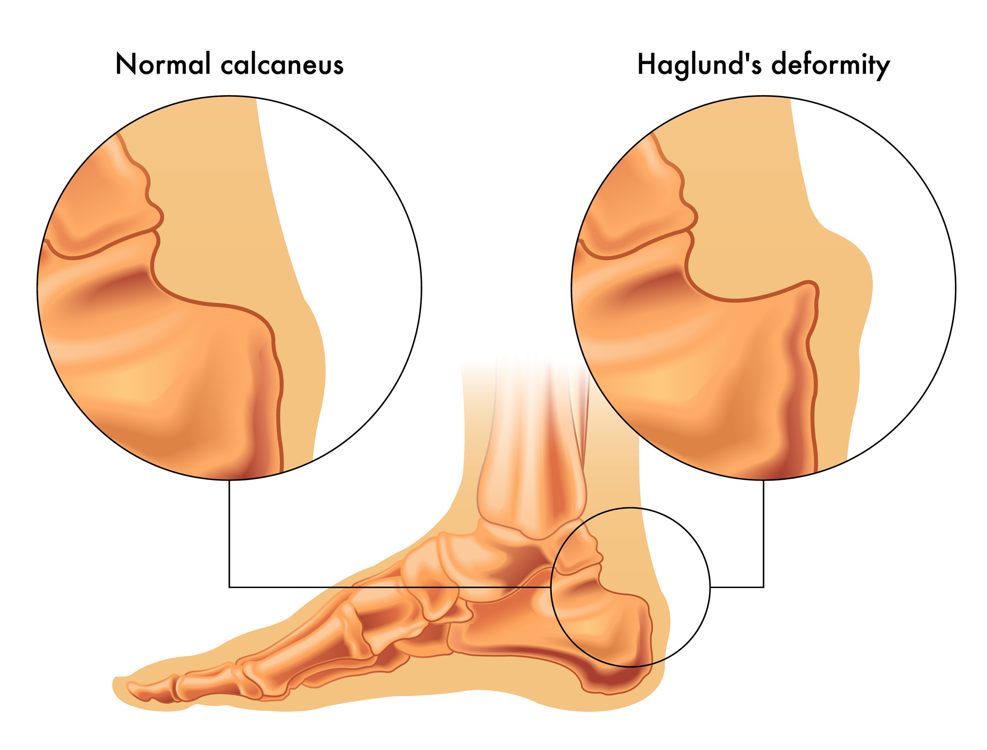 Is your heel pain plantar fasciitis? - Heiden Orthopedics