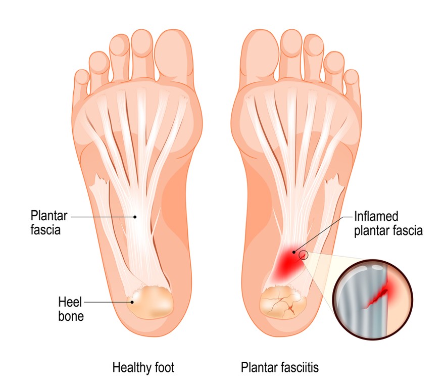 plantar fasciitis