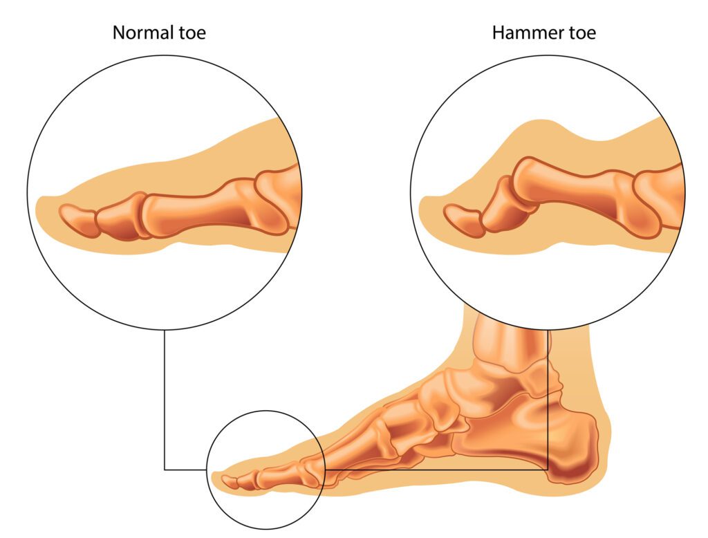 Hammer toes
