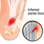 plantar fasciitis