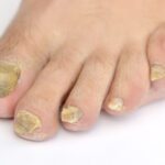 fungal nails